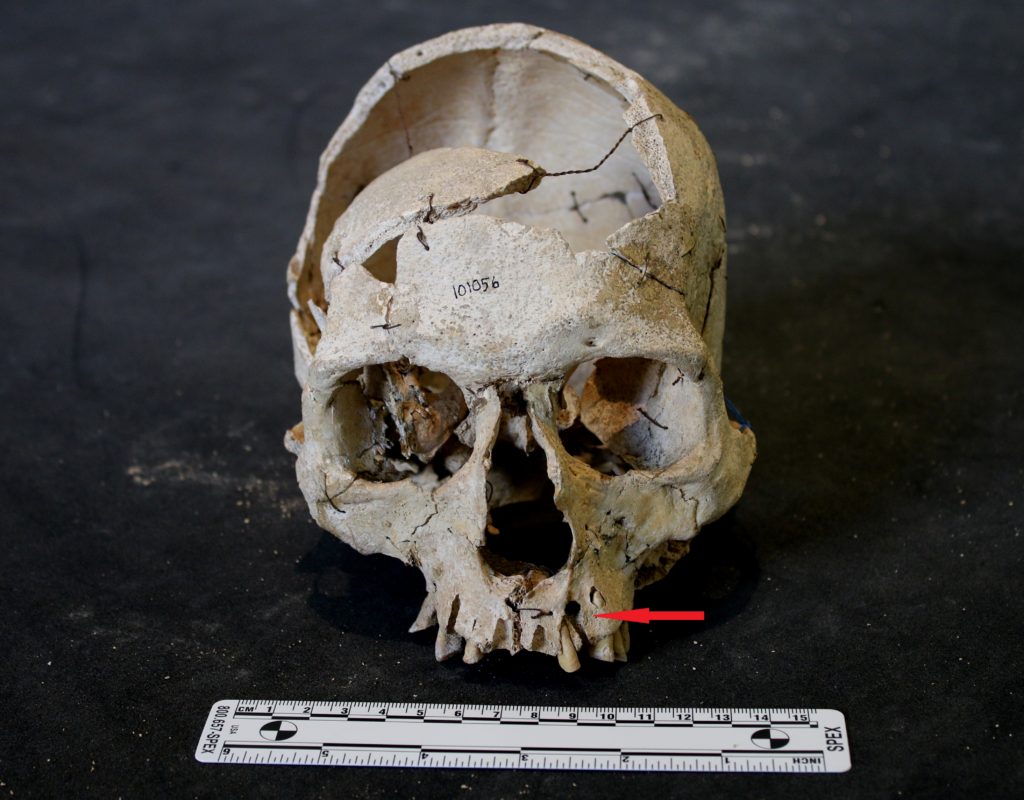 Moulsecombe skull (dental abscess arrowed)